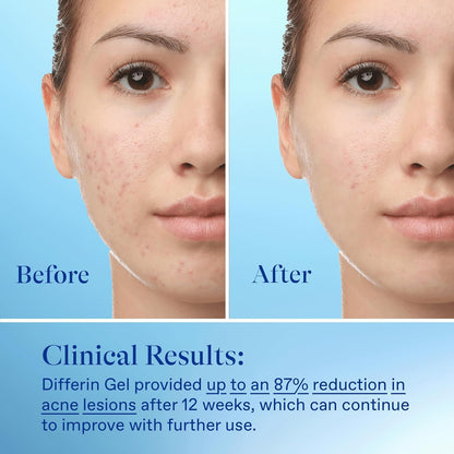 Differin Acne Treatment Gel